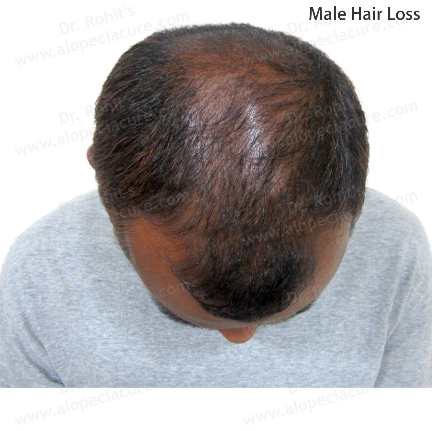 Male Hair Loss Clinical Treatment